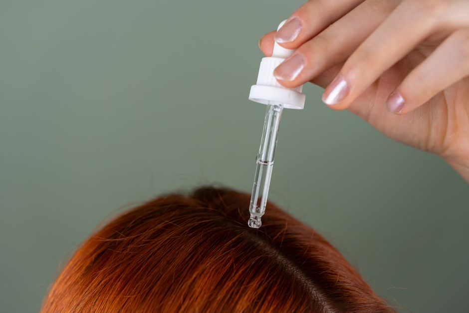 scalp psoriasis
