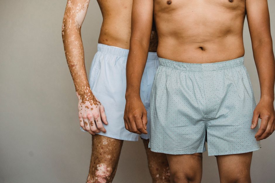 erythrodermic psoriasis