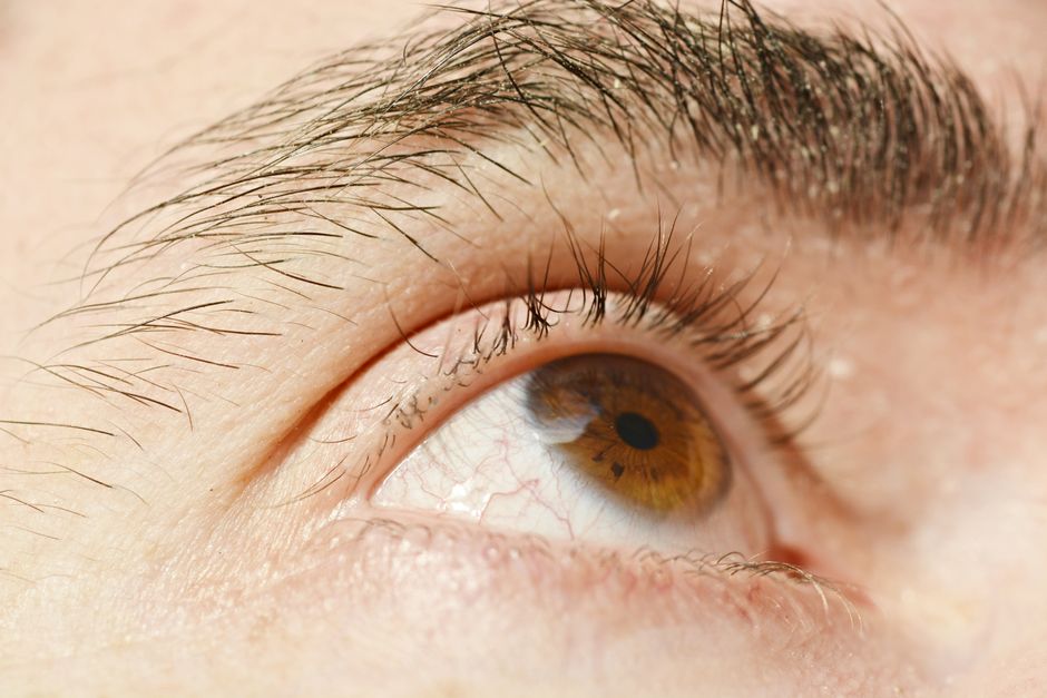 neurodermitis augen creme