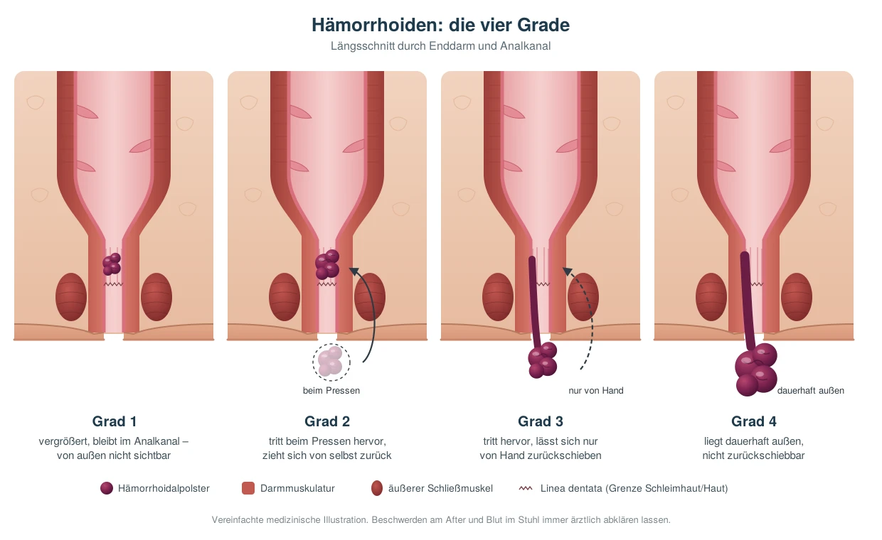 Hämorrhoiden Grad 1 bis 4: Illustration, wie Hämorrhoiden in den einzelnen Stadien aussehen