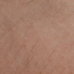 wie sieht nagelpilz aus