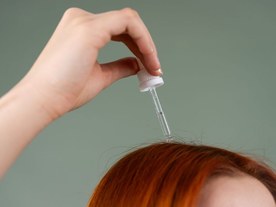 scalp psoriasis